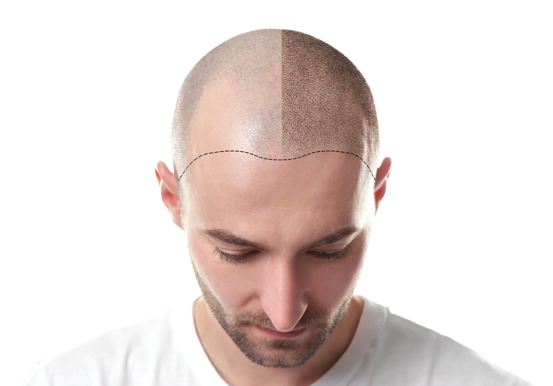 How to Stop Receding Hairline? 9 Science Backed Tips to Follow!