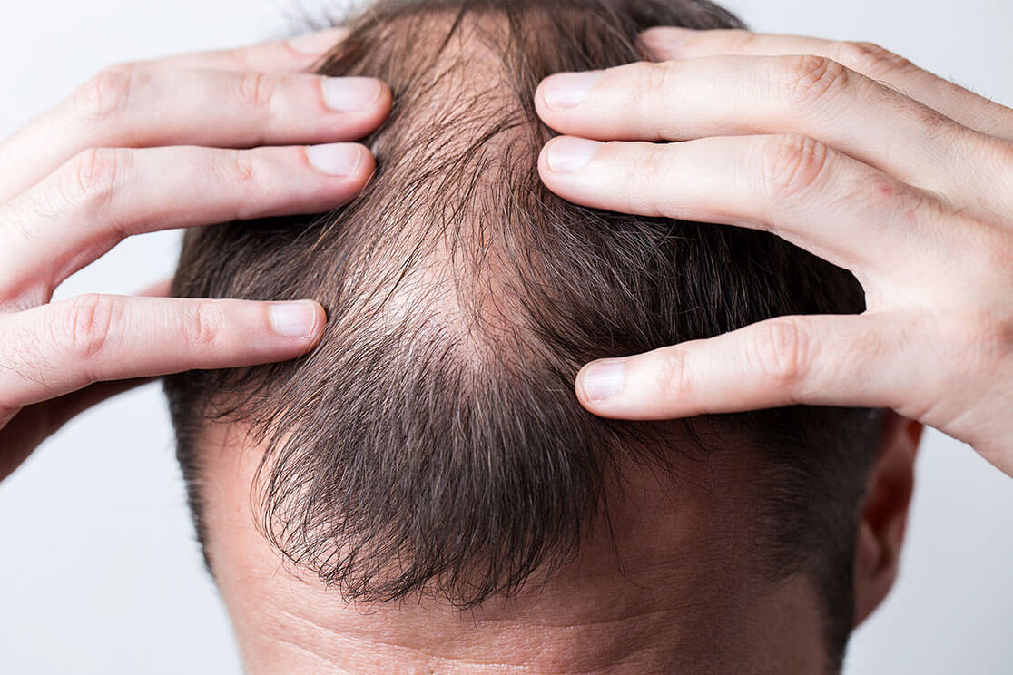 Close-up of the top of a man's head, with hair parted to expose hair loss