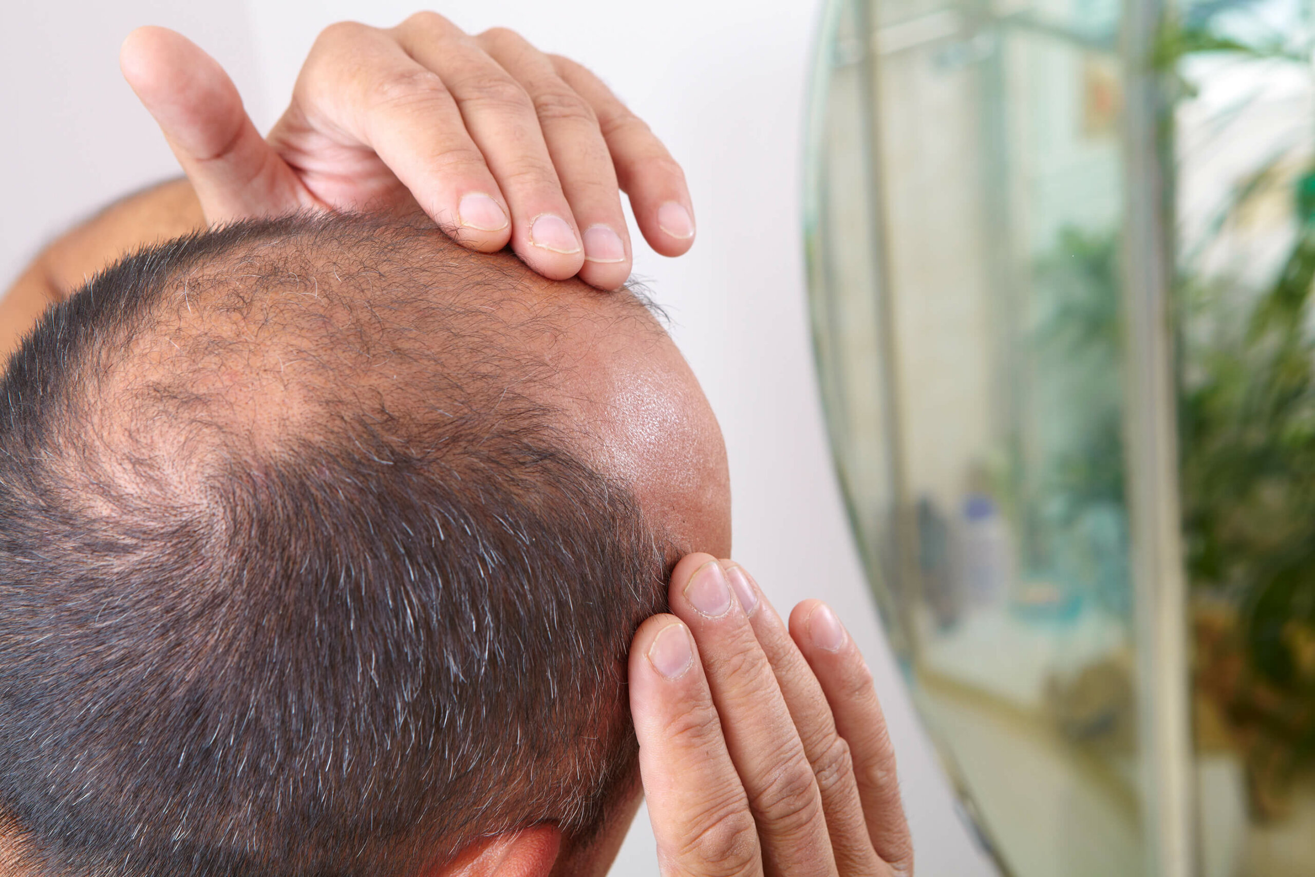 Close-up of the back of a man's head, showing androgenic alopecia that has caused thinning hair all along the top of the head