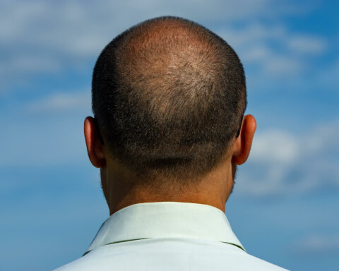 Dealing with a balding crown: why it happens and how to treat it - myhair