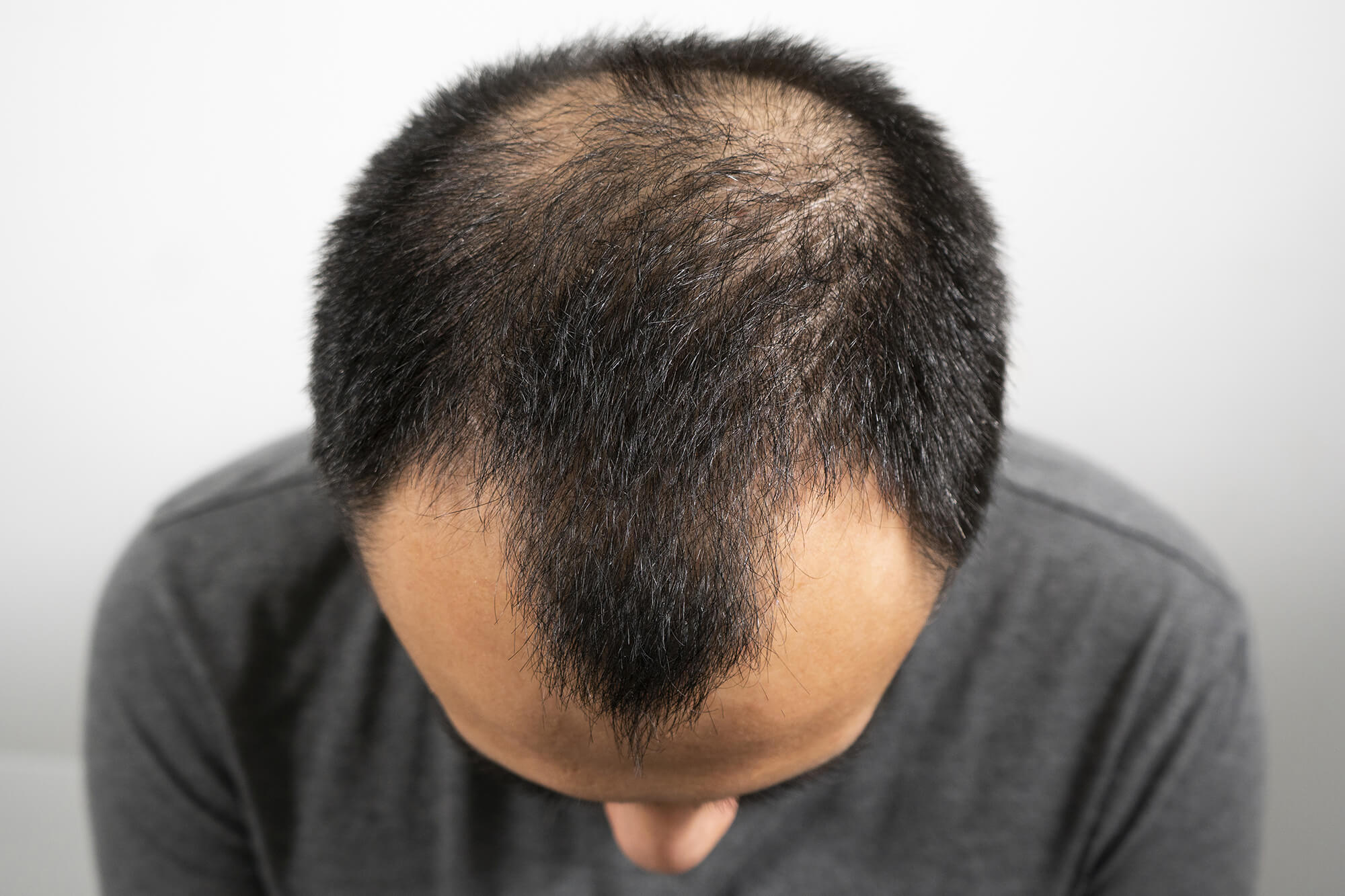 Close-up of a man's head, showing an M-shaped hairline and hair loss at the back of the head