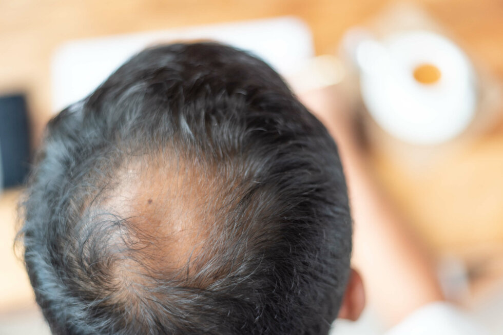 Why do men go bald (and will it happen to me)? - myhair