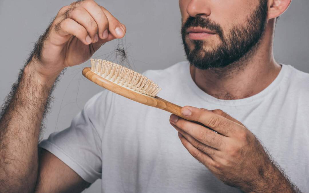 What is minoxidil shedding?