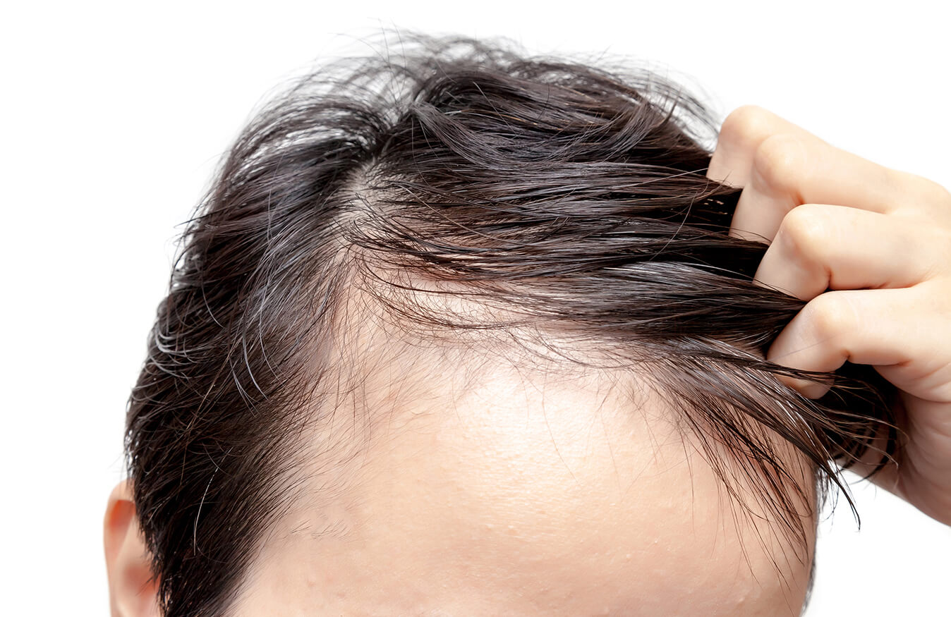 A close up of a scalp with thinning hair