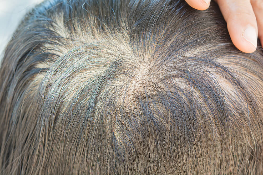 A close-up of a scalp with evenly distributed thinning hair