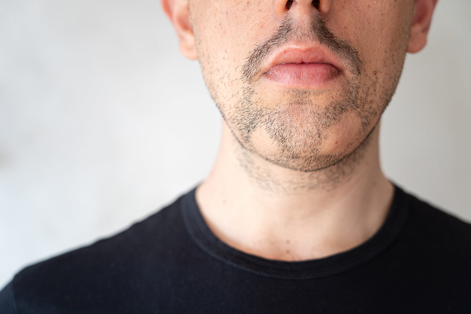 The bottom half of the face of a man with alopecia barbae.