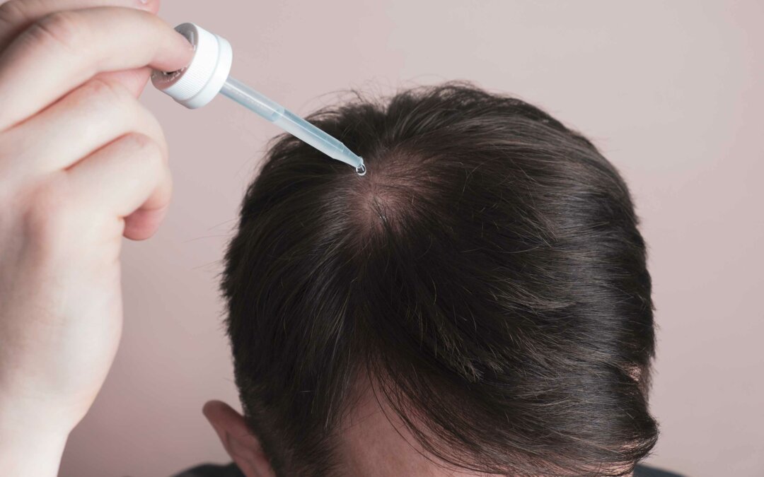 Can topical finasteride regrow hair?